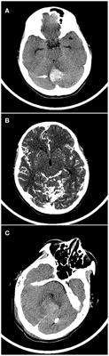 Associations of Clinical Characteristics and Etiology With Death in Hospitalized Chinese Children After Spontaneous Intracerebral Hemorrhage: A Single-Center, Retrospective Cohort Study